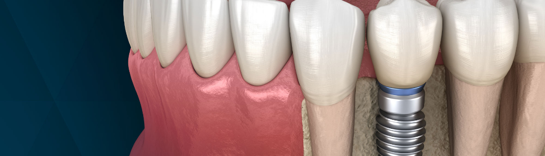 Solutions for a Missing Tooth - Dr. Kvitko & Associates